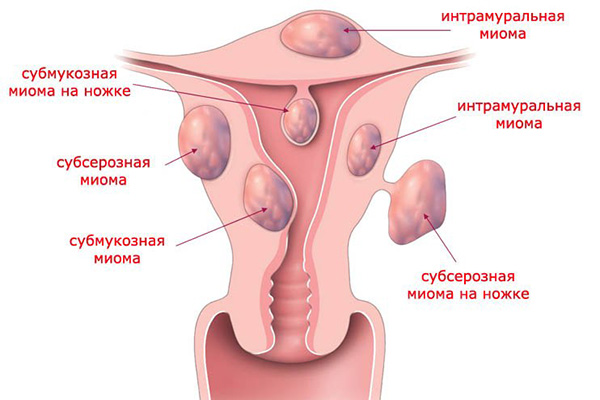 Міома матки: симптоми і ознаки при клімаксі що відбувається з пухлиною в період менопаузи лікування і чи завжди потрібна операція