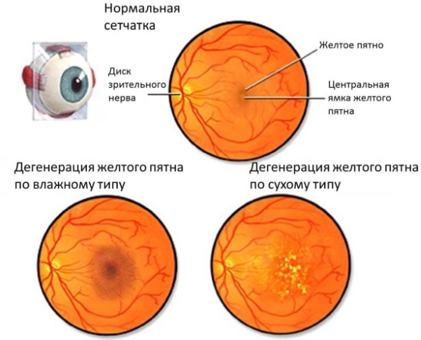 Макулодистрофія Сітківки Ока Лікування Народними Засобами