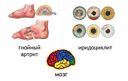 Менінгококовий сепсис або менінгококцемія симптоми у дітей і дорослих лікування можливість вижити