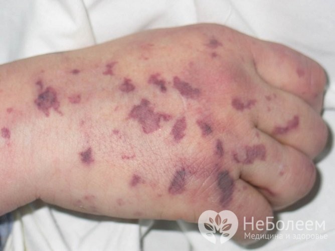 Менінгококовий сепсис або менінгококцемія симптоми у дітей і дорослих лікування можливість вижити