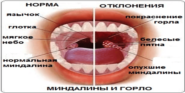 Методи лікування аденоїдів у дітей без операції