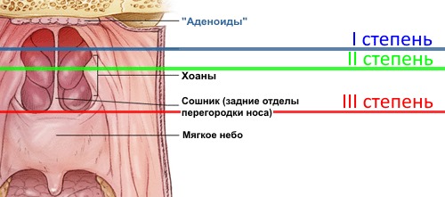 Методи лікування аденоїдів у дітей без операції