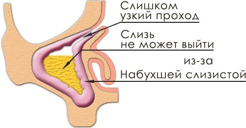 Методи лікування алергічного гаймориту