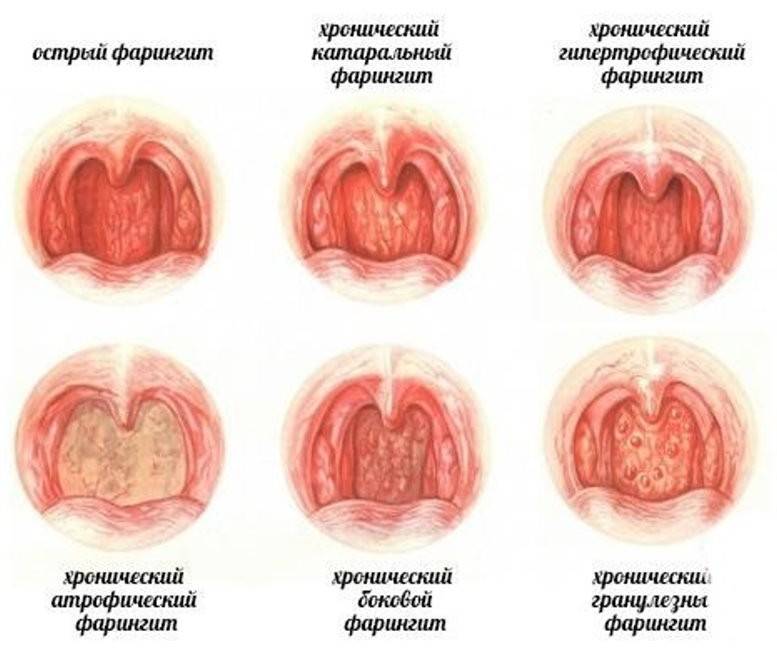 Методи лікування атрофічного субатрофического фарингіту