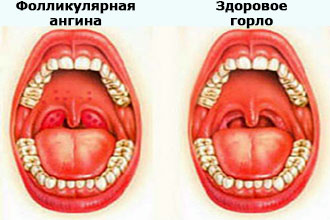 Методи лікування фолікулярної ангіни