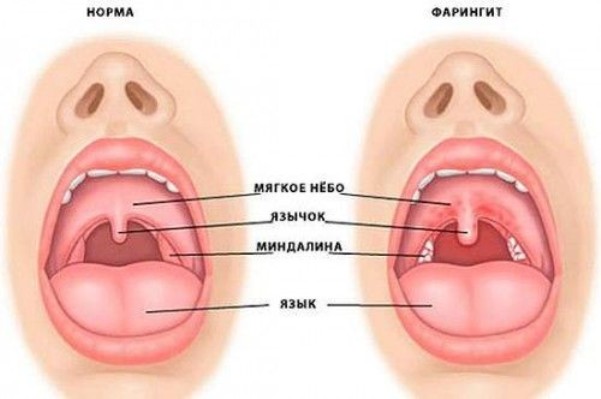 Методи лікування герпетичного фарингіту