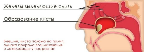 Методи лікування кісти утворилася в гайморових пазухах