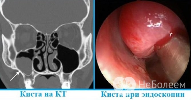 Методи лікування кісти утворилася в гайморових пазухах