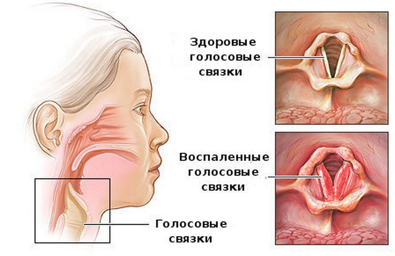 Методи лікування ларинготрахеїту у дорослих