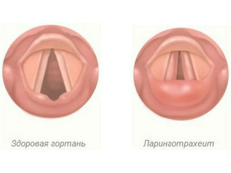 Методи лікування ларинготрахеїту у дорослих