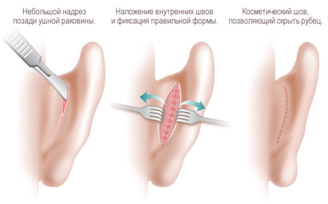 Методи виправлення капловухості без операції