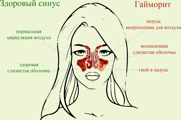 Методика промивання носа лікувальними розчинами. Як правильно промивати ніс солоною водою в домашніх умовах