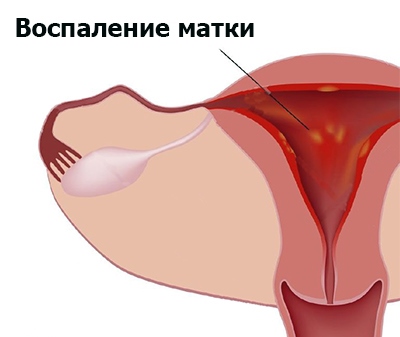 Метрит небезпечне захворювання матки яке легко лікуватися при ранній діагностиці