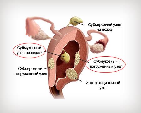 Множинні міоми матки малих розмірів