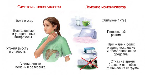 Моноцитарна ангіна: причини і симптоми