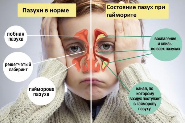 Може бути гайморит без нежиті і закладеності носа