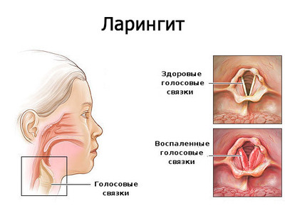 Може ларингіт бути заразним для оточуючих. Заразний ларингіт і як він передається