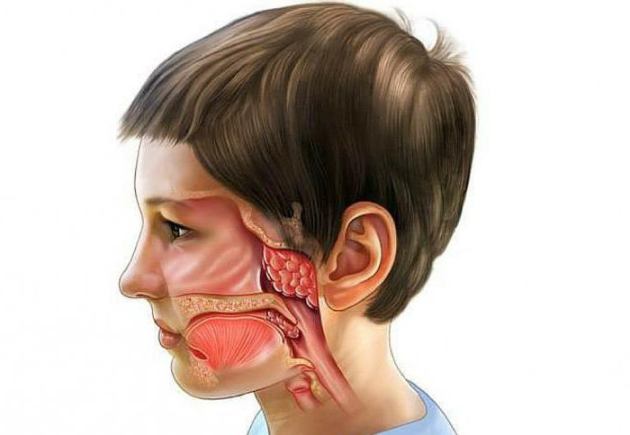 Може підвищуватися температура при аденоїдах у дітей і що робити? Може бути температура за аденоїдів