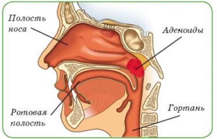 Може підвищуватися температура при аденоїдах у дітей і що робити? Може бути температура за аденоїдів