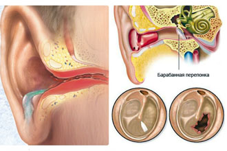 Можливі ускладнення після отиту