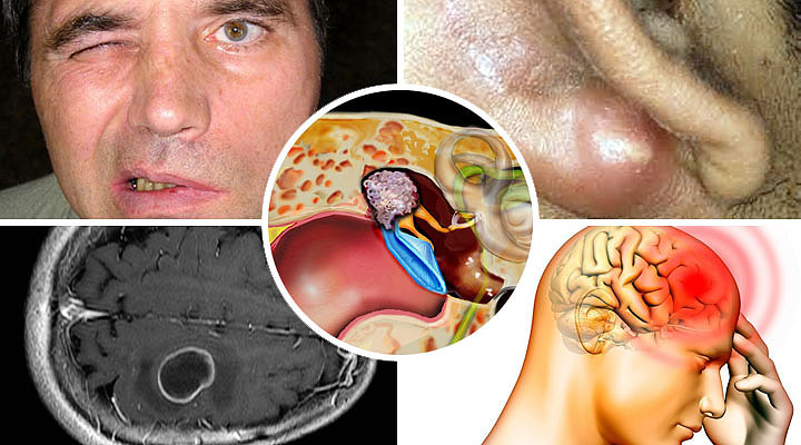 Можливі ускладнення після отиту