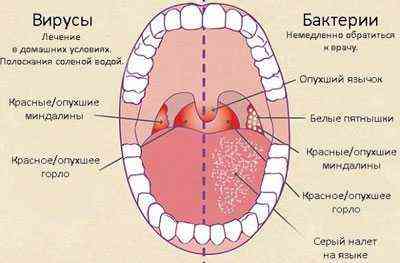 Чи можна гріти горло при лікуванні ангіни, фарингіту, ларингіту запалення гланд