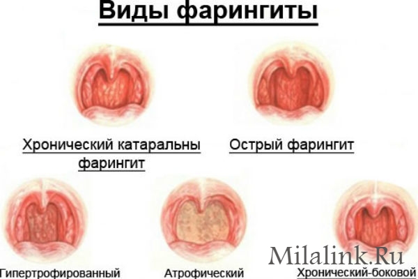 Чи можна гріти горло при лікуванні ангіни, фарингіту, ларингіту запалення гланд