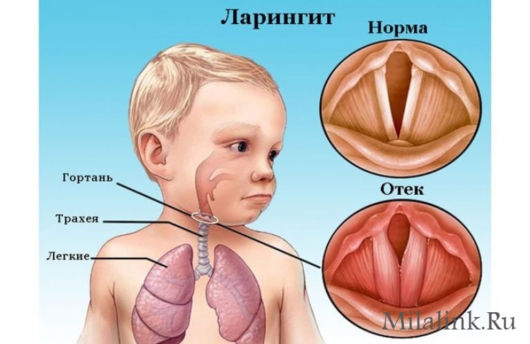 Чи можна гріти горло при лікуванні ангіни, фарингіту, ларингіту запалення гланд