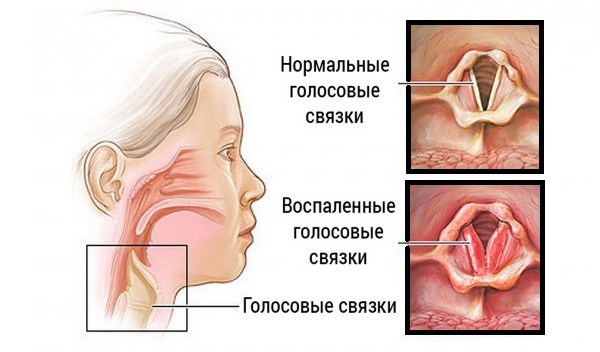 Чи можна палити коли болить горло