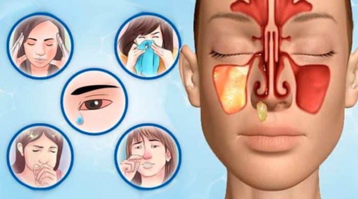 Чи можна робити інгаляції при гаймориті