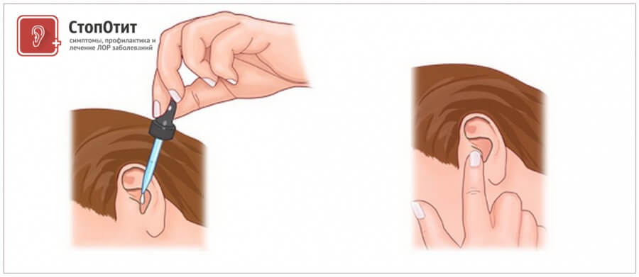 Чи можна закапати сульфацил натрію у вуха