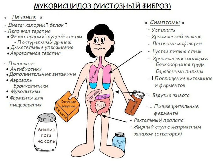 Муковісцидоз у дорослих – симптоми, ознаки, лікування
