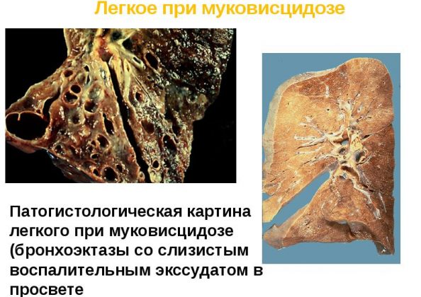 Муковісцидоз у дорослих – симптоми, ознаки, лікування