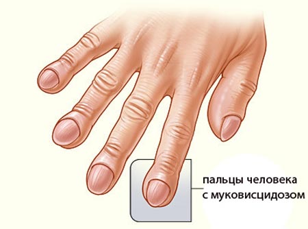 Муковісцидоз у дорослих – симптоми, ознаки, лікування