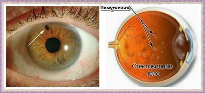 Мушки перед очима причини лікування народними засобами
