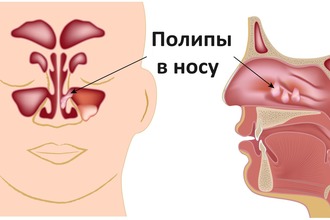 Чим лікувати гайморит при грудному вигодовуванні