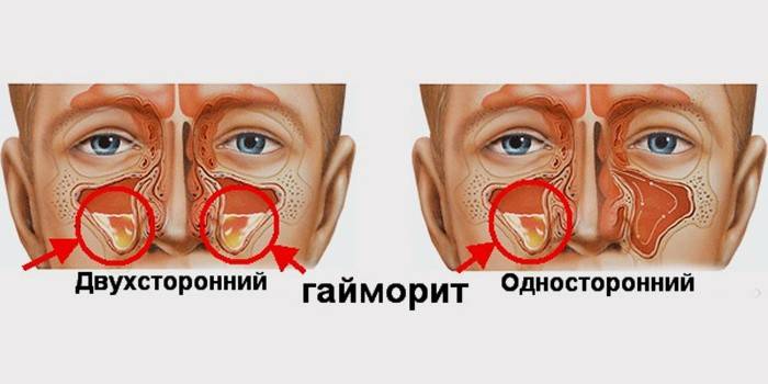 Чим лікувати гайморит у дорослих