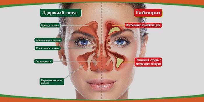 Чим лікувати гайморит у дорослих
