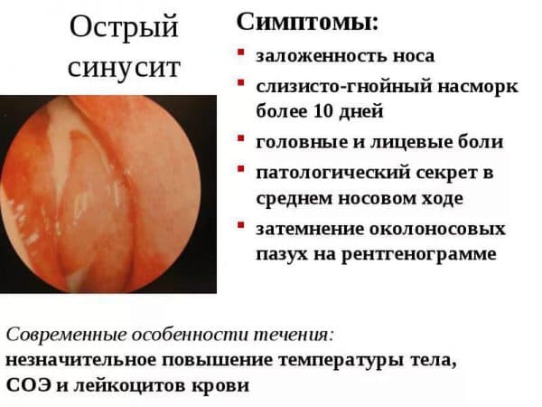 Чим лікувати головний біль при гаймориті