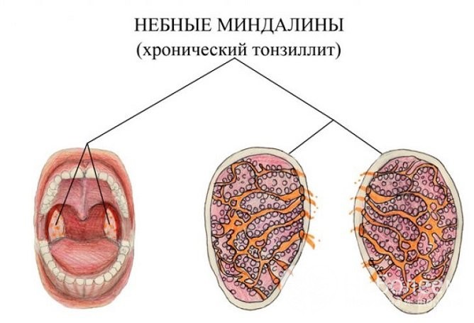 Чим лікувати хронічний тонзиліт у дорослих
