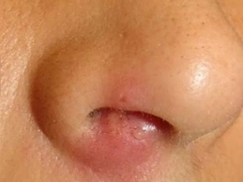 Чим лікувати нежить в носі — як швидко прибрати?