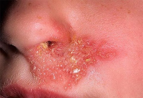 Чим лікувати нежить в носі — як швидко прибрати?