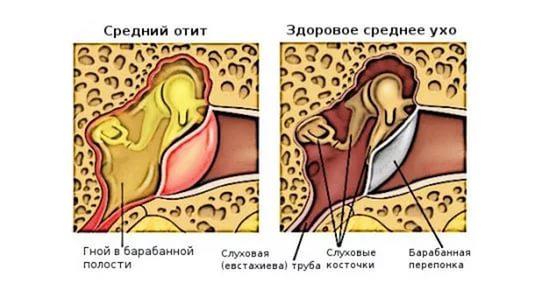 Чим лікувати отит вуха у ребнка