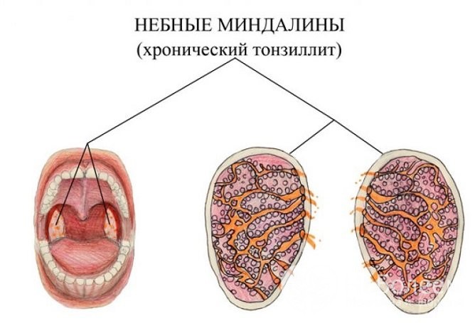 Чим лікувати тонзиліт у дорослого