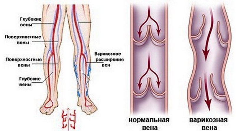 Чим лікувати вени на ногах народними засобами