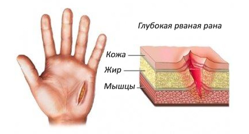 Чим витягнути гній з під шкіри прища в домашніх умовах