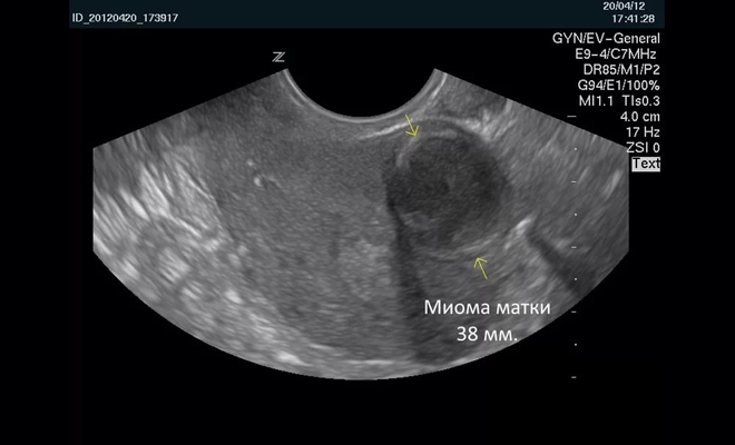 На який день циклу робити УЗД при міомі матки