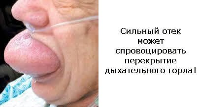 Набряк Квінке: перші симптоми, правила першої допомоги. Особливості набряку Квінке — причини, лікування і профілактика – Автор Катерина Данилова