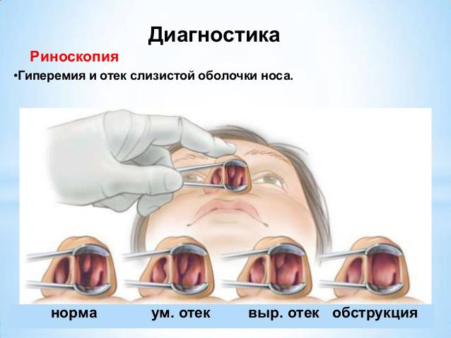 Набряк слизової носа – причини, лікування і як його зняти 2019