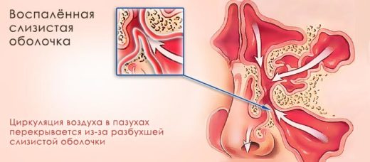 Набряково катаральний гайморит симптоми і лікування